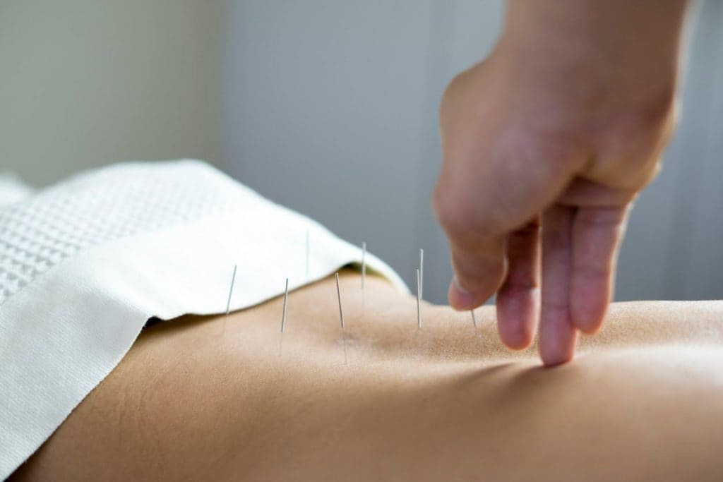 Acupuncture therapy illustration